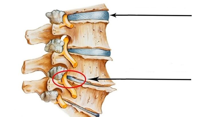 poranenie chrbtice v prípade cervikálnej osteochondrózy