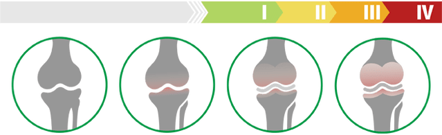 Klinické štádiá artrózy kolenného kĺbu (stupeň artrózy kolenného kĺbu)