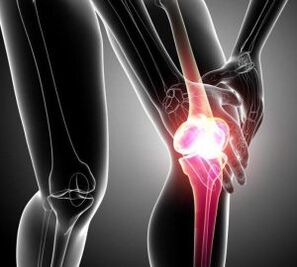 bolesť kolena pri artritíde a artróze