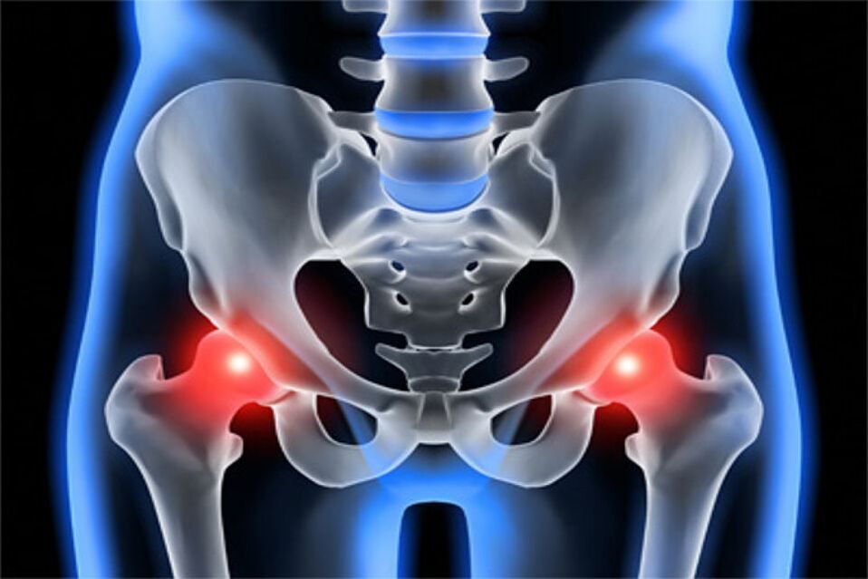 Deformujúca artróza bedrových kĺbov (koxartróza)