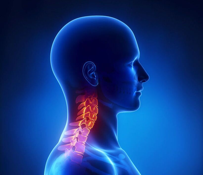 Cervikálna osteochondróza je patológia chrbtice, ktorej sa môžete zbaviť doma