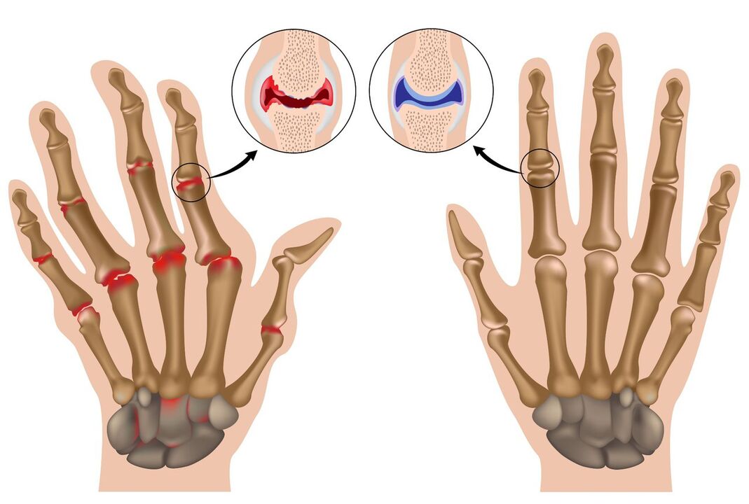Zdravé kĺby rúk postihnuté polyartritídou