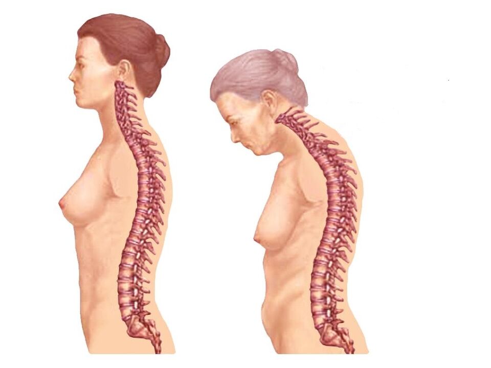 zdravá zakrivená chrbtica s osteochondrózou