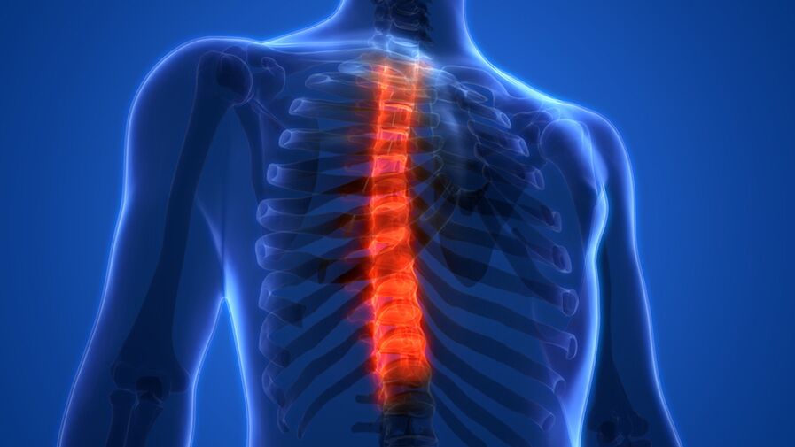 Osteochondróza hrudnej chrbtice, charakterizovaná deštrukciou medzistavcových platničiek