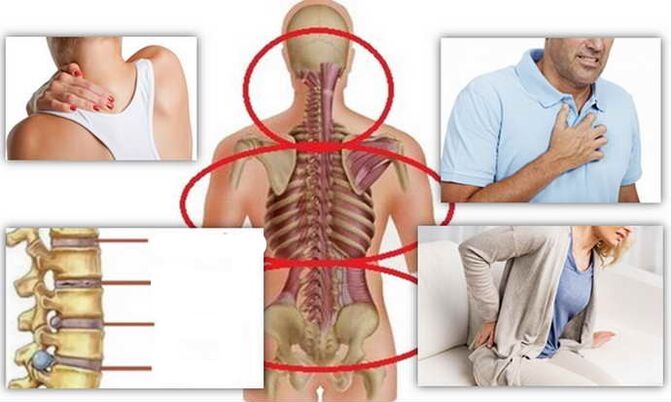 Miesta choroby na osteochondrózu