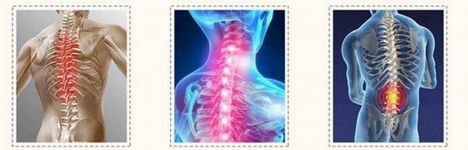 osteochondróza miechové lézie