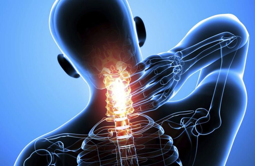 Osteochondróza krčnej chrbtice