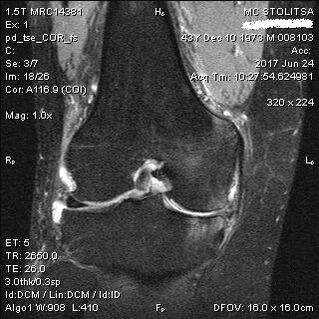 Osteoartróza kolenného kĺbu na MRI